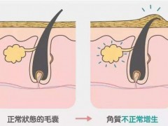 怎么去除身上的鸡皮肤这几方法很可行（二）-医药代理网
