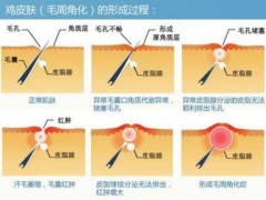 怎么去除身上的鸡皮肤这几方法很可行（三）-医药代理网