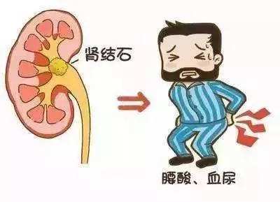 肾结石是如何形成的？