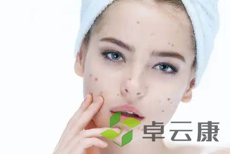 痘痘