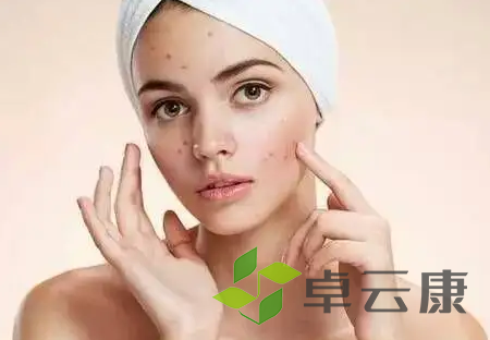 痘痘1