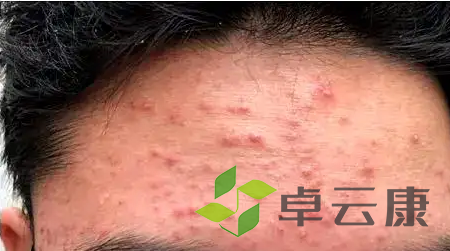 痘痘3