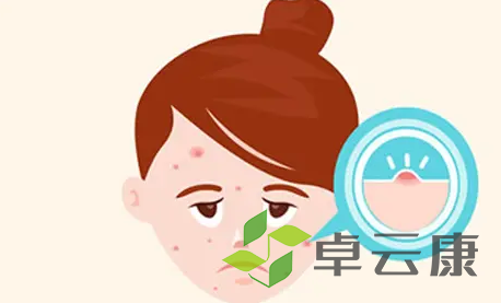 痘痘4