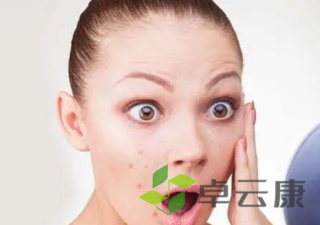 痘痘5