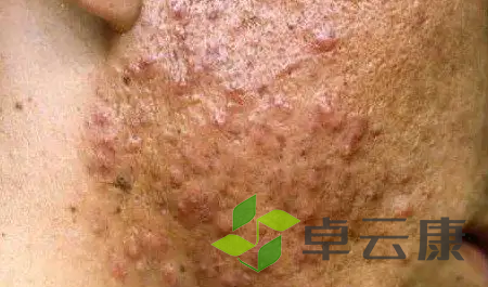 痘痘8