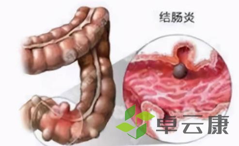 解除