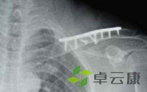 骨折