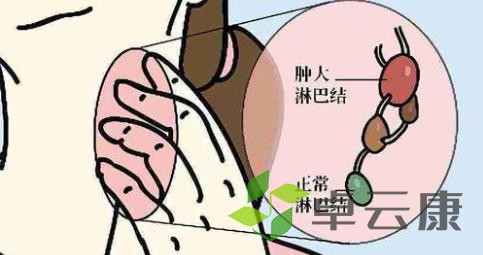 淋巴炎