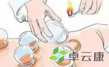 拔火罐