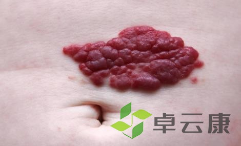 血管瘤